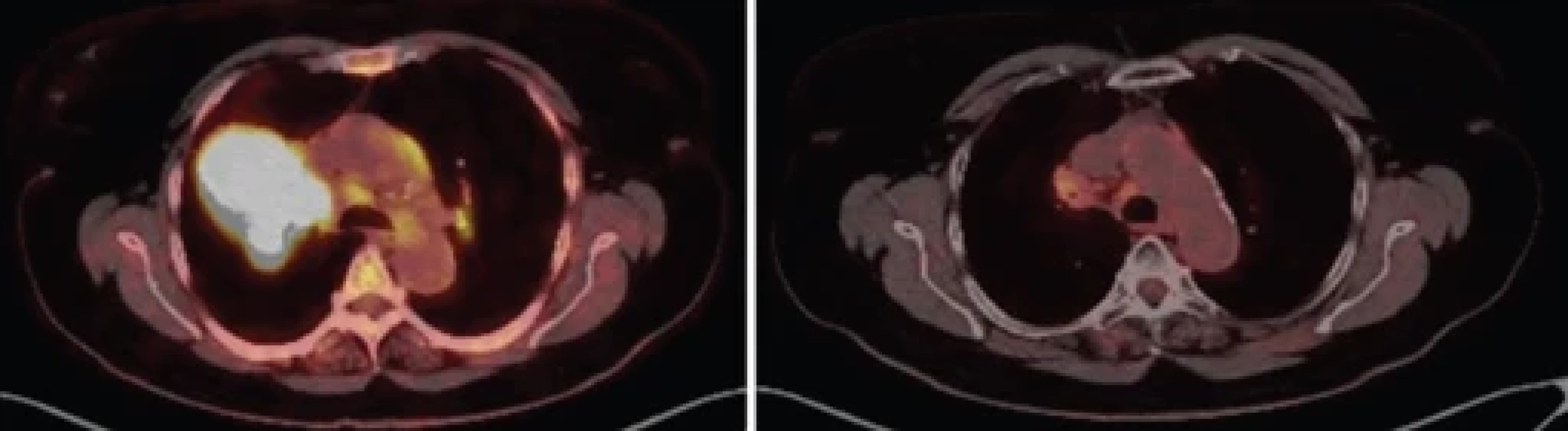 PET/CT při stanovení diagnózy a po léčbě cemiplimabem a radioterapií.