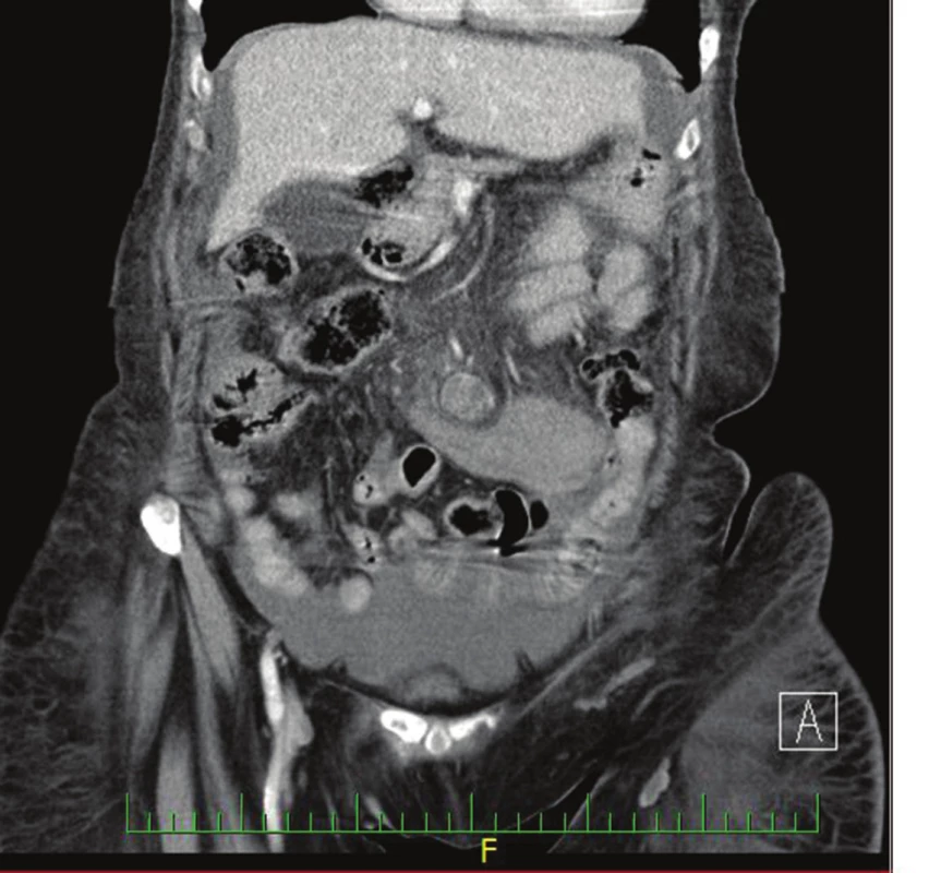 CT nález potvrzující krvácení v blízkosti horní mezenterické tepny
Fig. 2: CT finding confirming bleeding near the superior mesenteric artery