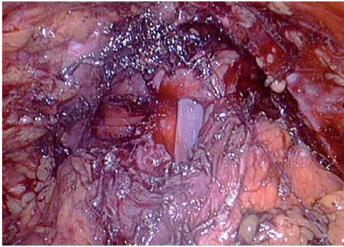 Veziko-uretrální anastomóza
Fig. 7. The vesico-urethral anastomosis