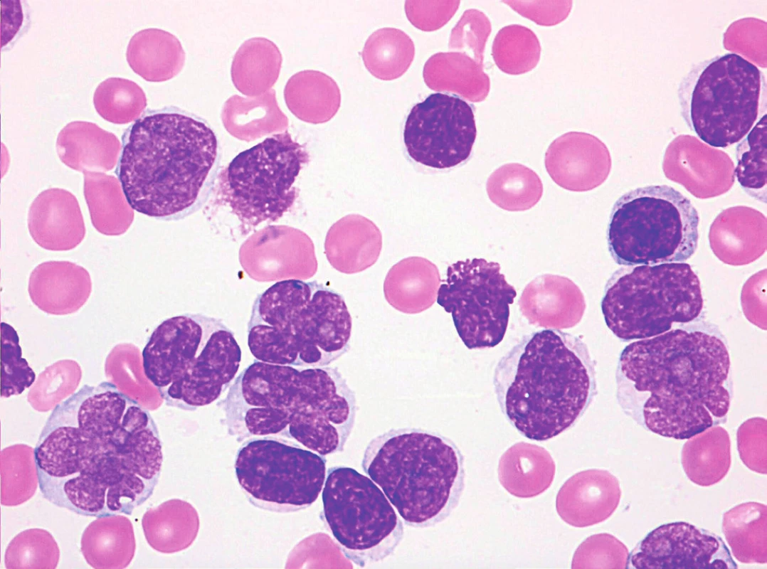 MCL, pleomorfní varianta s prolymfocytoidními rysy (v popředí jaderné atypie), nátěr kostní dřeně, barvení May-Grünwald, Giemsa-Romanowski, světelná mikroskopie, zvětšení 1000krát