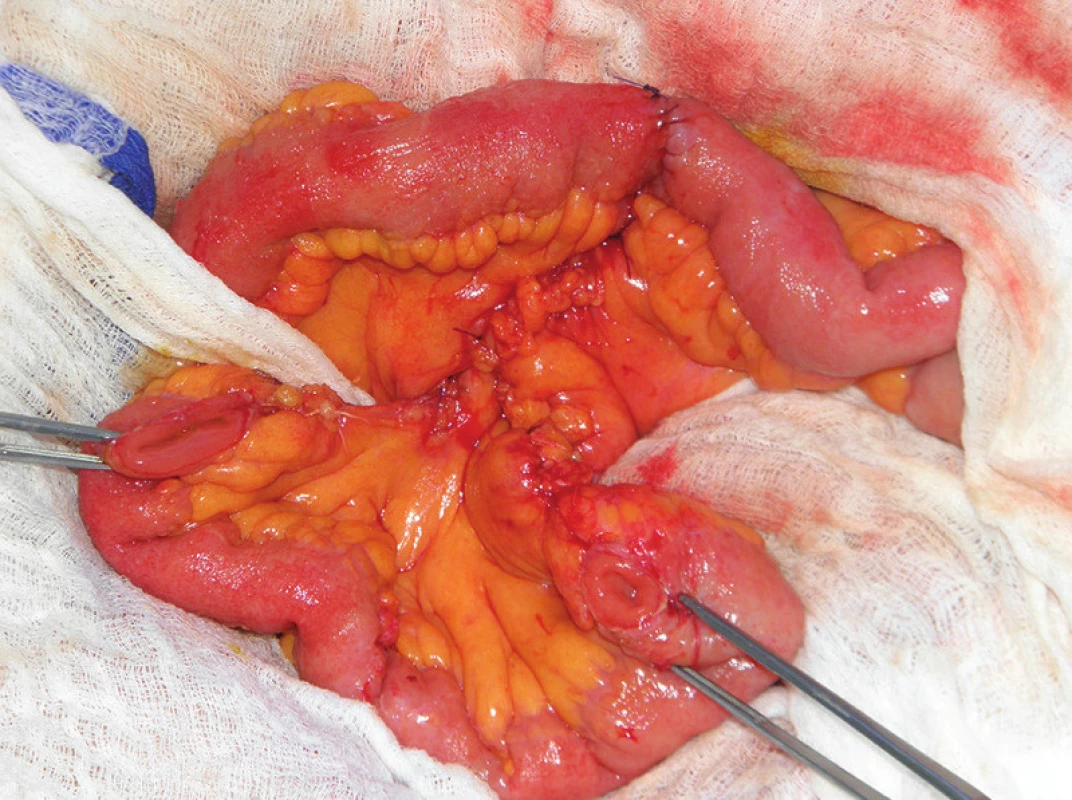 Operační nález: klička ilea exkludovaná z pasáže, ileoileální anastomóza end-end
Fig. 4: Surgical finding: loop of the ileum, excluded from the passage, ileo-ileo anastomosis end-to-end