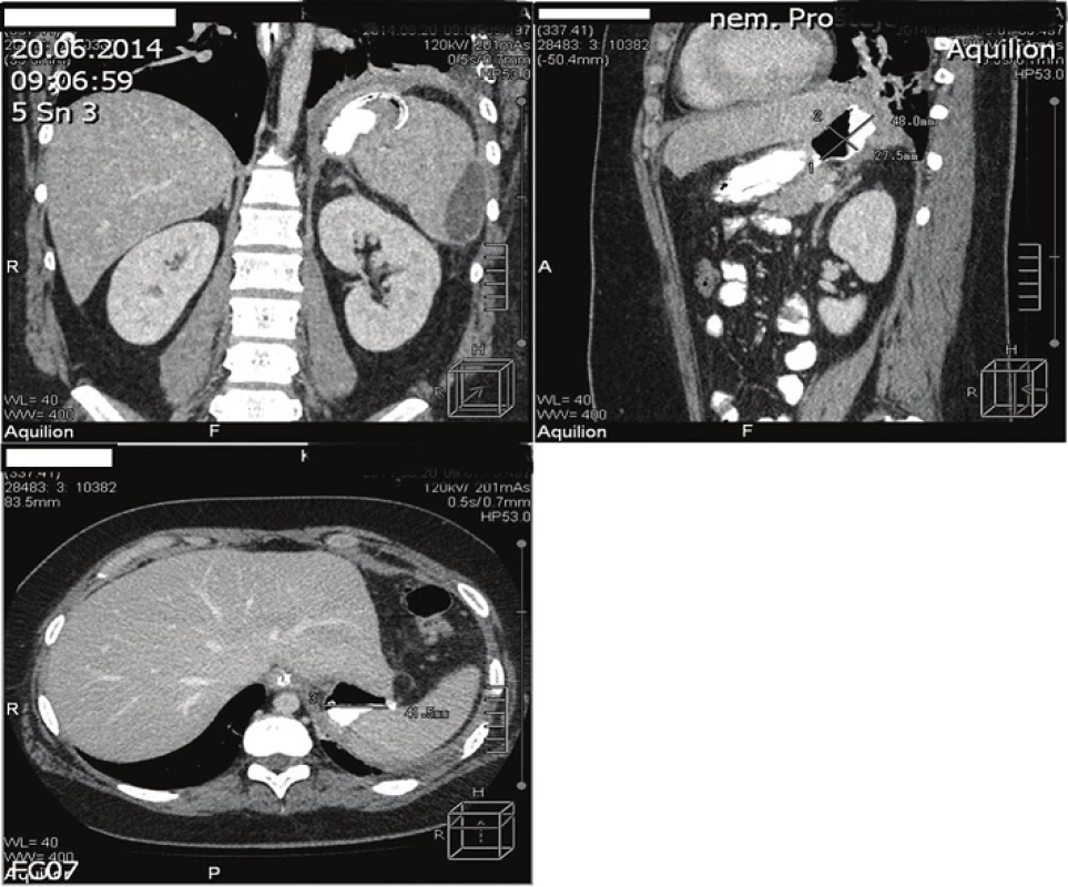 CT obrázek akutní kolekce v levém subfreniu při leaku po LGCP
Fig. 3: CT scan of acute left subphrenic collection due to a leak after LGCP