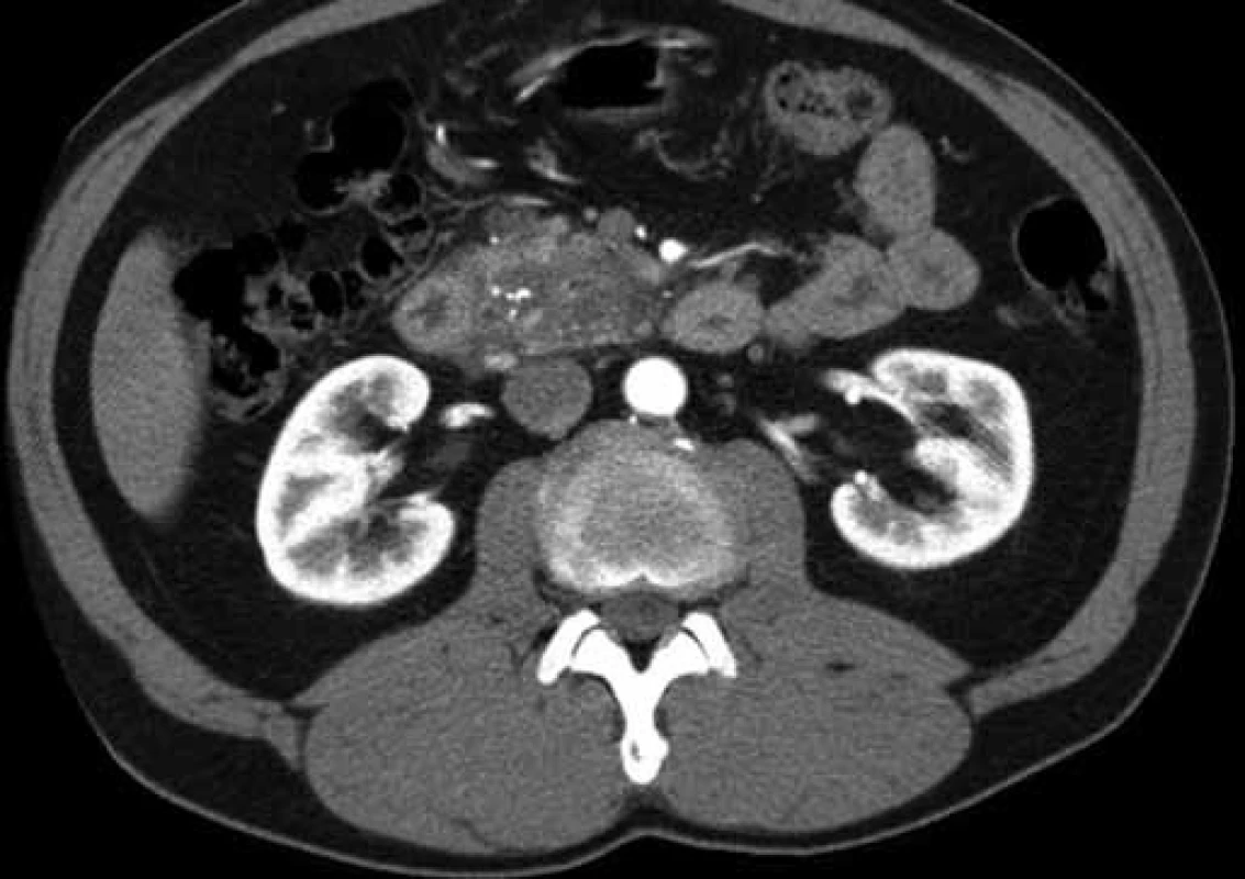 CT scan of a patient with GP: suspected pancreatic head cancer (patient 2).
Obr. 1. CT snímok pacienta s GP: vyslovené podozrenie na karcinóm hlavy pankreasu (pacient č. 2).