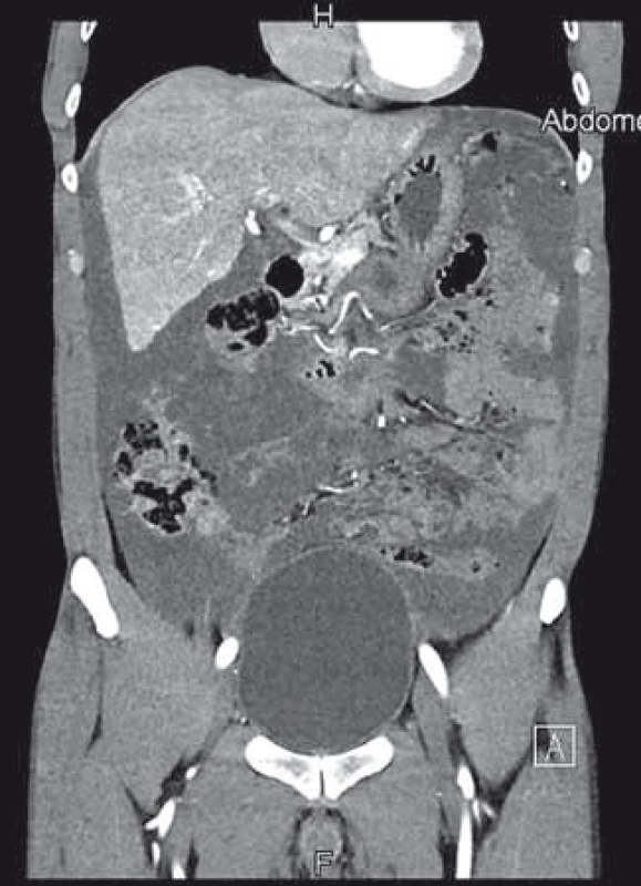 První CT vyšetření s nálezem galatinózních hmot vyplňujících dutinu břišní.
Fig. 1. First abdominal CT scan showing the abdominal cavity filled with mucoid fluid.