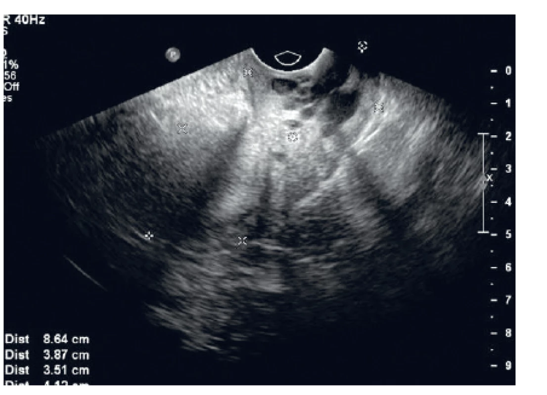 UZ endometria
