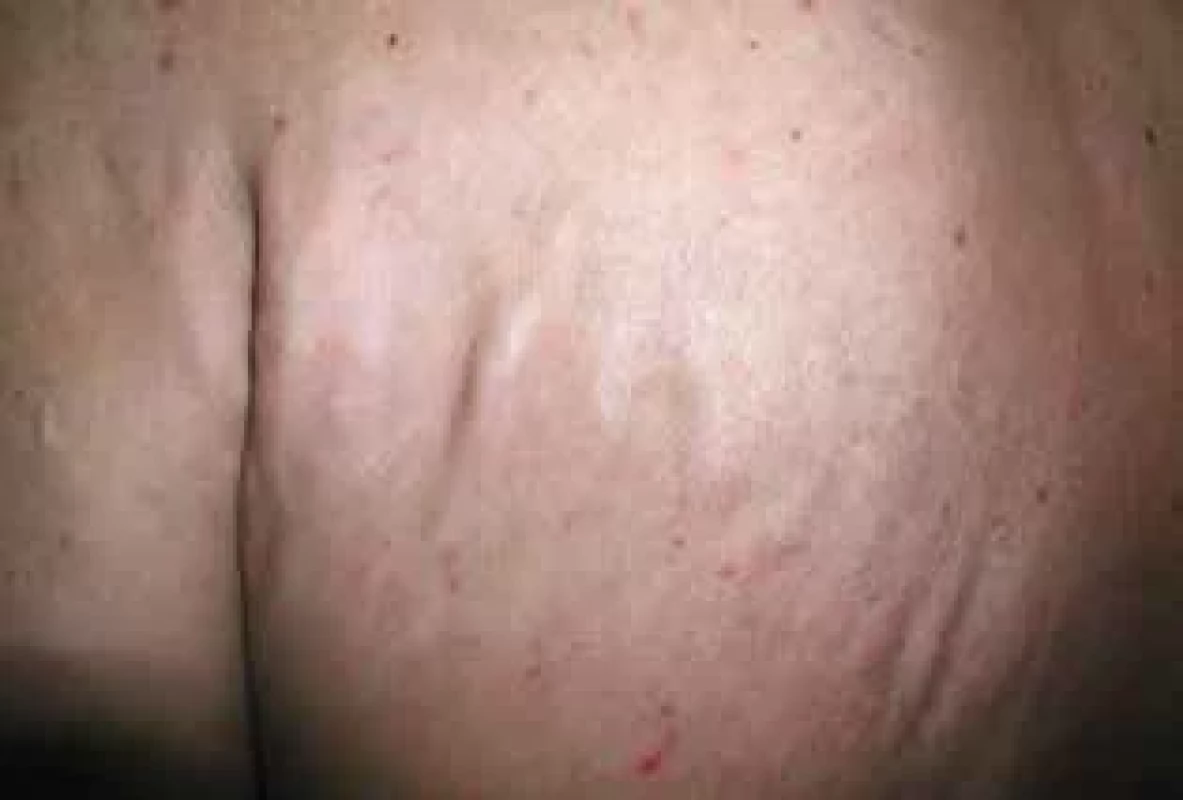 a,b. Klinický obraz různých forem dystrofické kalcifikace u dermatomyozitidy