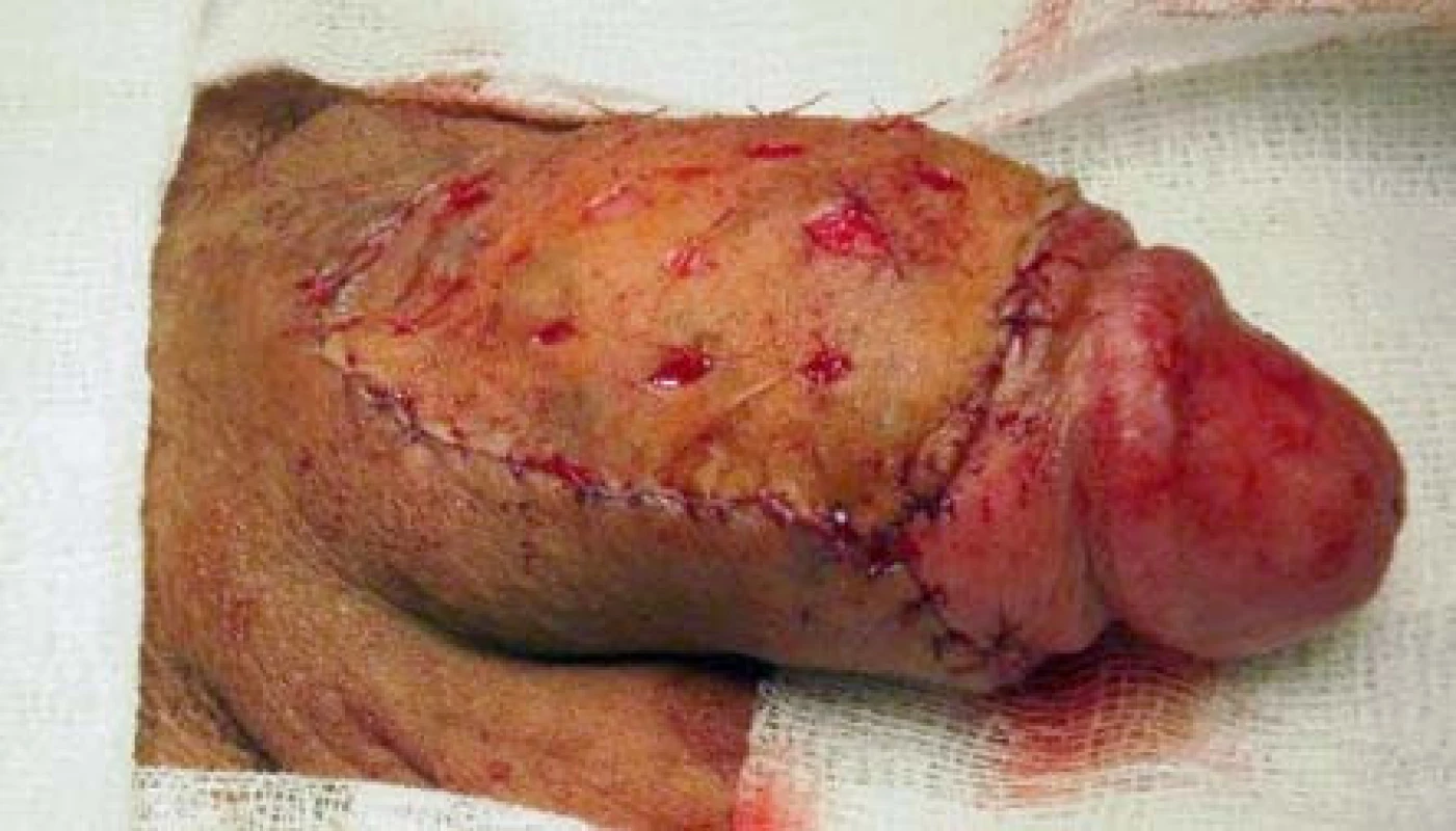 Cirkumcize a plastika dermoepidermálním štěpem
Fig. 3. Circumcision and reconstruction with split-thickness skin graft – STSG