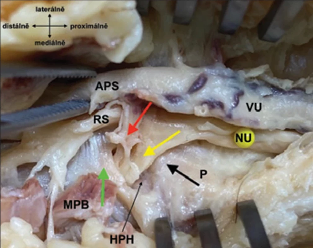 Detailní pohled na vstup ramus  profundus nervi ulnaris (žlutá šipka) a ra mus palmaris profundus arteriae ulna ris (červená šipka) do hiatus pisohamatus,  ohraničeného dorzálně pomocí ligamen tum pisohamatum (černá šipka) a palmárně  vazivově-svalovým začátkem svalů hypo thenaru (zelená šipka). Fig. 12. Detailed view of the entry of the ra mus profundus nervi ulnaris (yellow arrow)  and ramus palmaris profundus arteriae ul naris (red arrow) into the hiatus pisohama tus, bordered dorsally by the ligamentum  pisohamatum (black arrow) and palmarly  by the connective tissue-muscle origin of  the hypothenar muscles (green arrow).