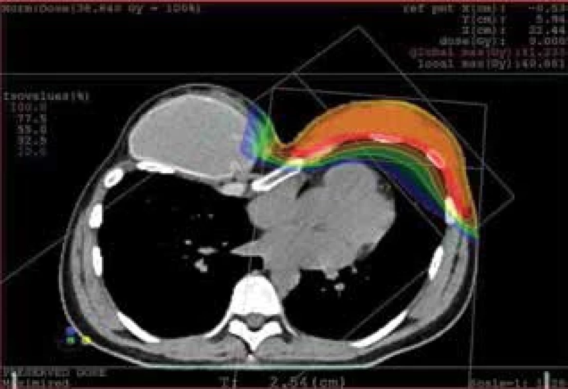 Pectus excavatum, vpadlý hrudník: pokrytí cílového objemu oranžově, pokles dávky v barevném rozlišení izodóz, jednoznačná ochrana srdce a plic. Oproti klasickým fotonovým technikám je téměř zcela chráněno srdce a velká část přilehlé plíce. Také kontralaterální prs je vyloučen z ozářeného objemu.