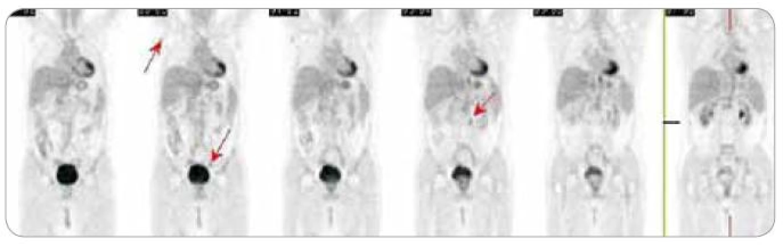 PET + CT srpen 2010.