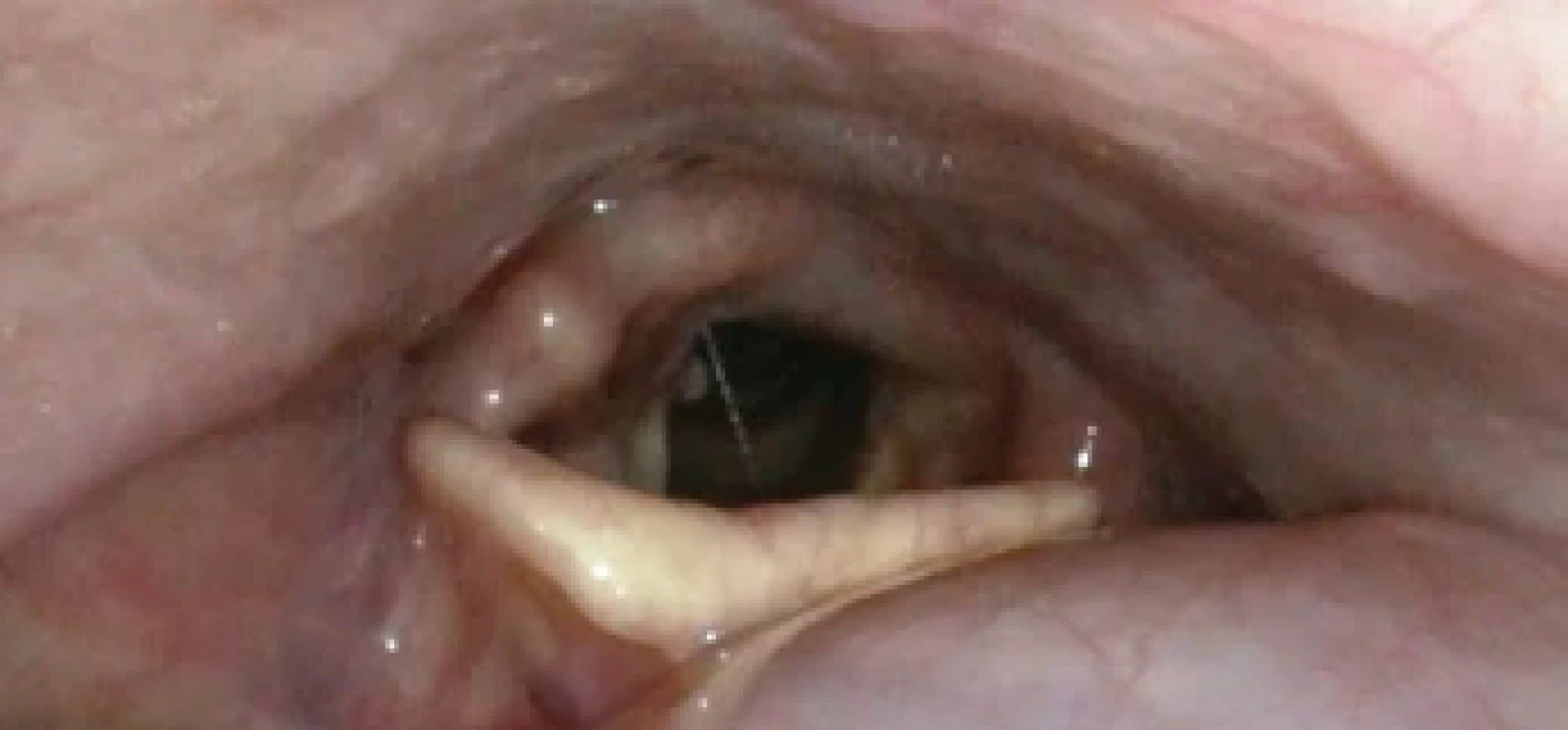 Předoperační vyšetření fl exibilní laryngoskopii – volné nitro hrtanu.Preoperative examination of fl exible laryngoscopy – unobstructed laryngeal
interior.
