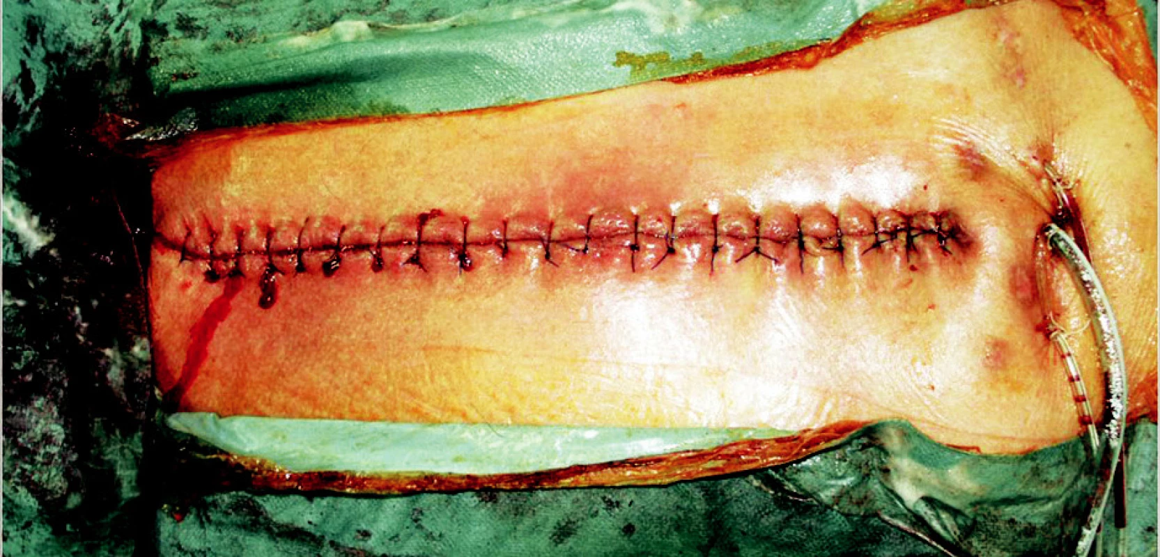 Stav po rekonstrukci hrudní stěny oboustranným posunem pektorálních svalů 
Fig. 6. The result after the chest reconstruction by bilateral advancement pectoral flap