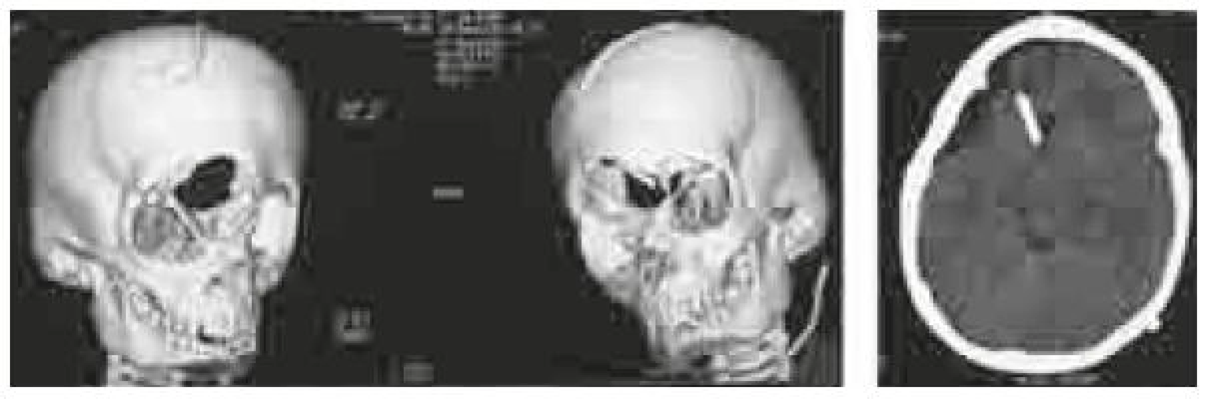 Pacient 1, CT dokumentácia pred plánovaním rekonštrukcie kosteného defektu.
Na 3D rekonštrukcii frontálny defekt pokračuje defektom v strope orbity a chýbaním časti krídla nosovej kosti. Rovinný rez dokumentuje takmer vyprázdnené komory a reziduum po subarachnoidálnej cyste, katéter vo frontálnom rohu vpravo je spoločným vyvedením pre oba likvorové priestory.