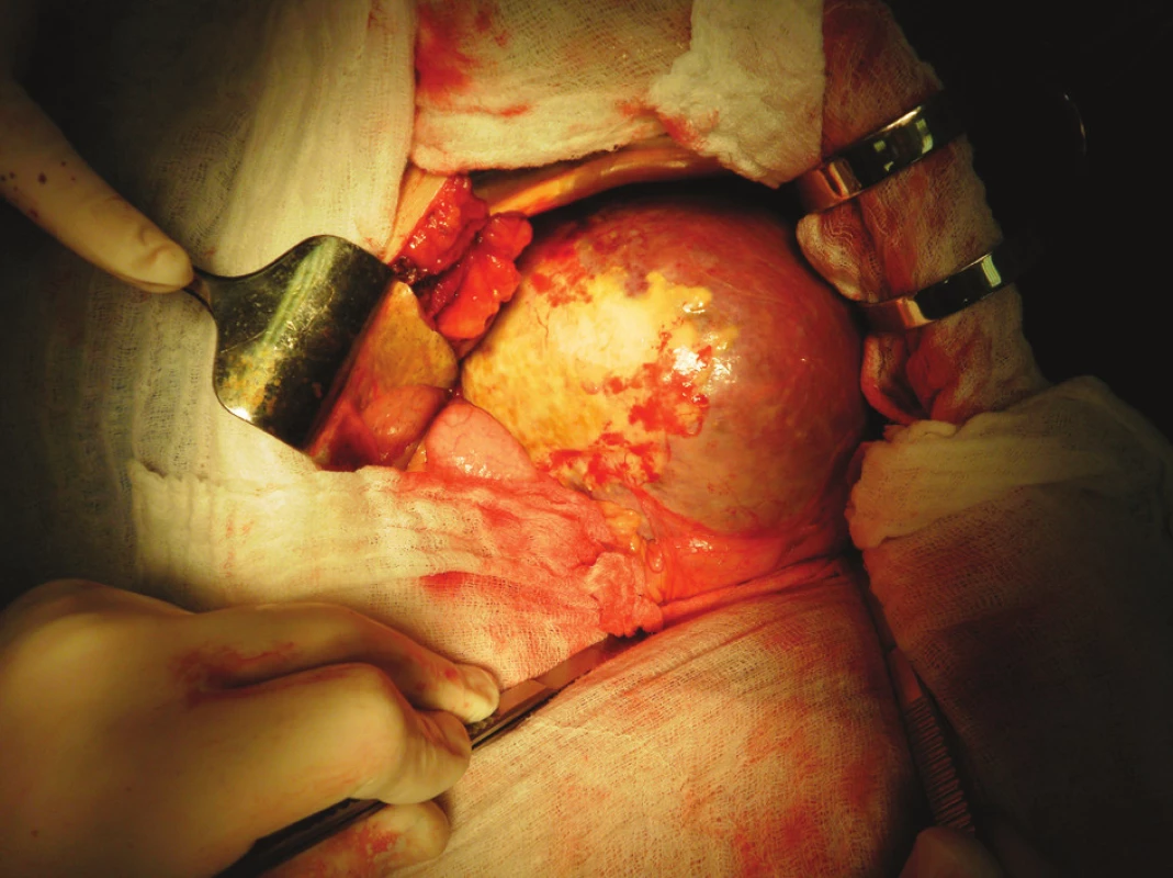 Poúrazová pseudocysta sleziny – peroperační nález
Fig. 4. Post-traumatic pseudocyst of the spleen on CT scan – intraoperative finding