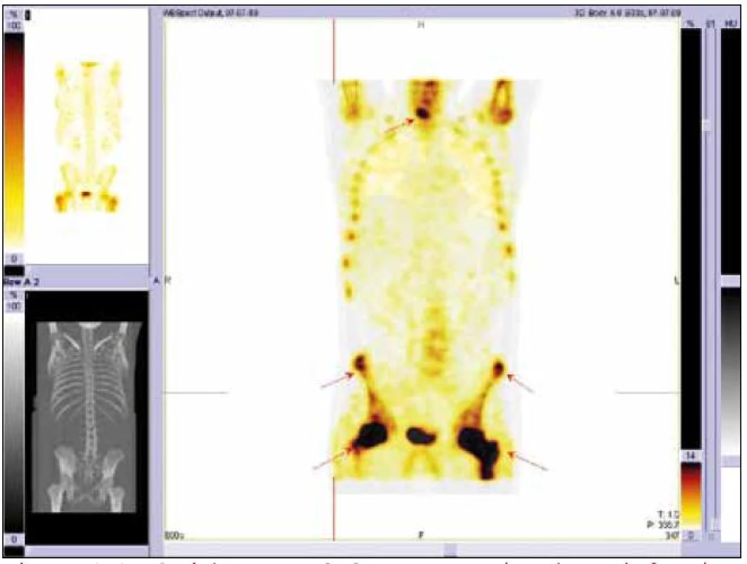 Scintigrafie skeletu Tc pyrofosfátem. Výrazná akumulace radiofarmaka je zřetelná v proximálních částech femurů a ložiska zvýšené aktivity jsou vidět i v některých dalších oblastech.