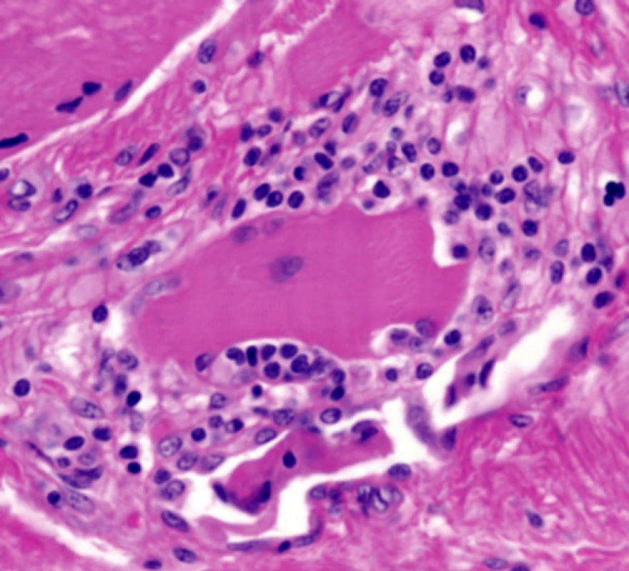 Histologický obraz polymyozitidy
