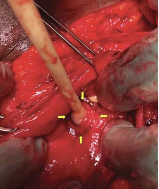 Yellow arrows show the fistula orifice with the Foley catheter in the opening (published with the patient's permission). // Žluté šipky zobrazují ústí píštěle se zavedeným foleyovým katetrem (publikováno se svolením pacientky).