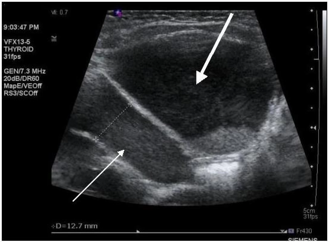 Ultrasonografie, pacient č. 2; silnější šipka ukazuje zvýšeně echogenní abnormální sediment v moči v močovém měchýři; slabší šipka ukazuje na podobný obsah v levém močovodu, který je rozšířen na 12,7 mm.

Fig. 1. Ultrasound, patient No 2; note increased echogenicity of urine sediment in the bladder (thick arrow); similar urine sediment is in the lumen of dilated (diameter 12.7 mm) left ureter (thin arrow).