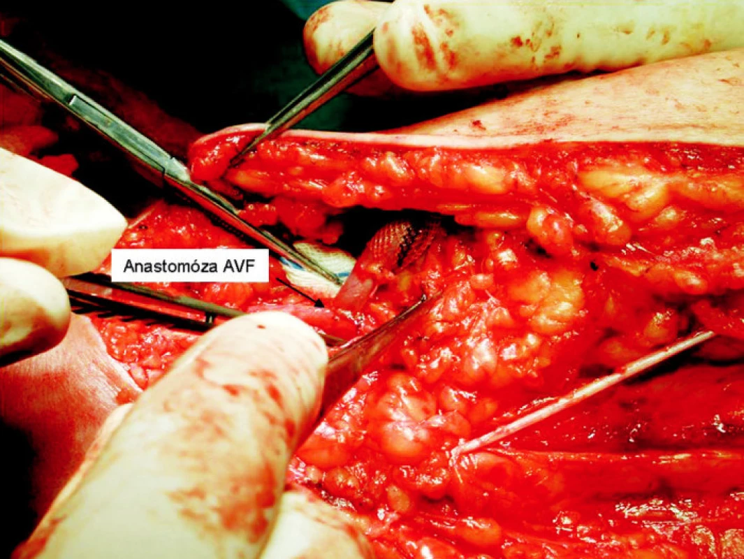 Anastomóza vena basilica s arteria brachialis
Fig. 4. Anastomosis between the vena basilica and arteria brachialis