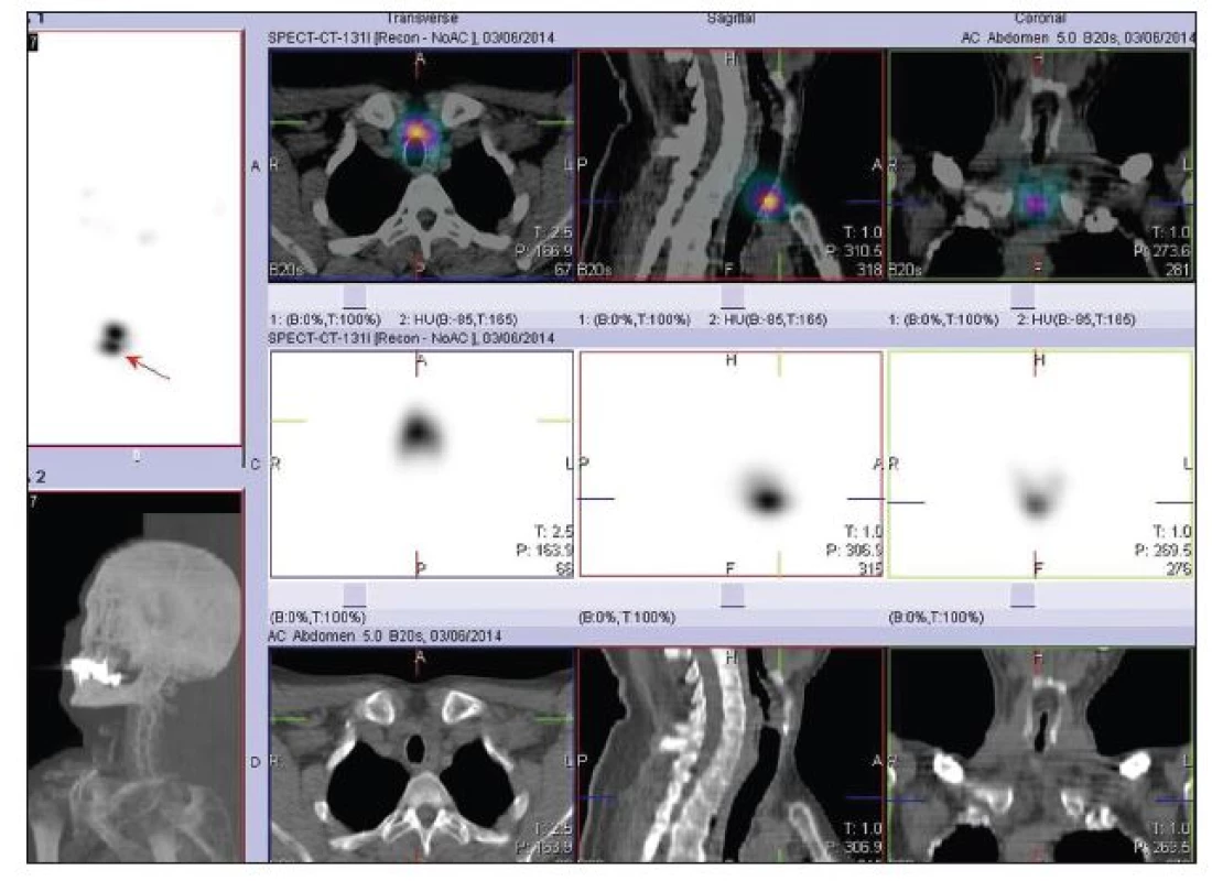 SPECT/low dose CT krku po terapii <b>7,4 GBq <sup>131</sup>I</b> s výrazně kontrastní depozicí <b>radiojódu</b> ve střední rovině v oblasti jugula odpovídající reziduu štítné žlázy.