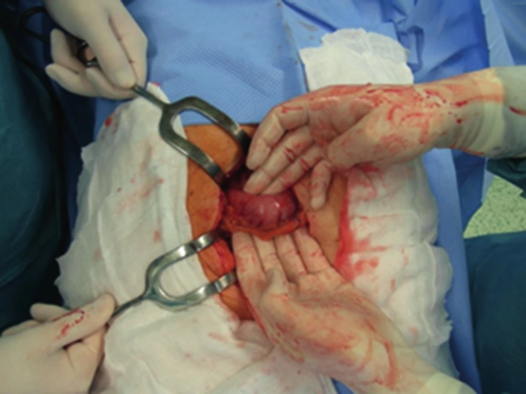 Vymasírovaný konkrement do antra žaludku
Fig. 3: Gallstone extruded into antrum of stomach