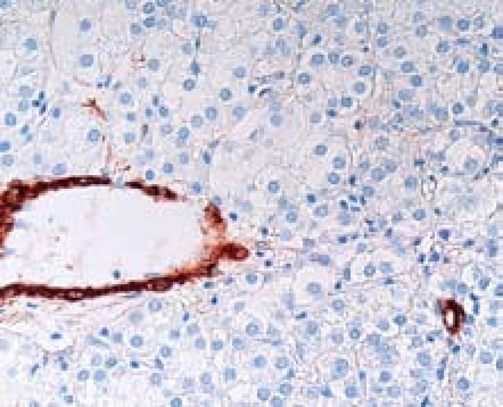 Nepárové arterie (hnědě) v HCC. Arterie leží samostatně v nádorové tkáni. Imunohistochemický průkaz hladkosvalového aktinu, zvětšení objektiv 40×.
Fig. 2. HCC with unpaired arteries (brown) which are not accompanied by bile ducts as in portal tracts of normal liver. Detection of alfa-smooth muscle actin, high power field. 