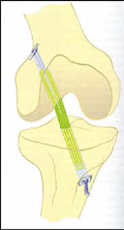 Endobutton position