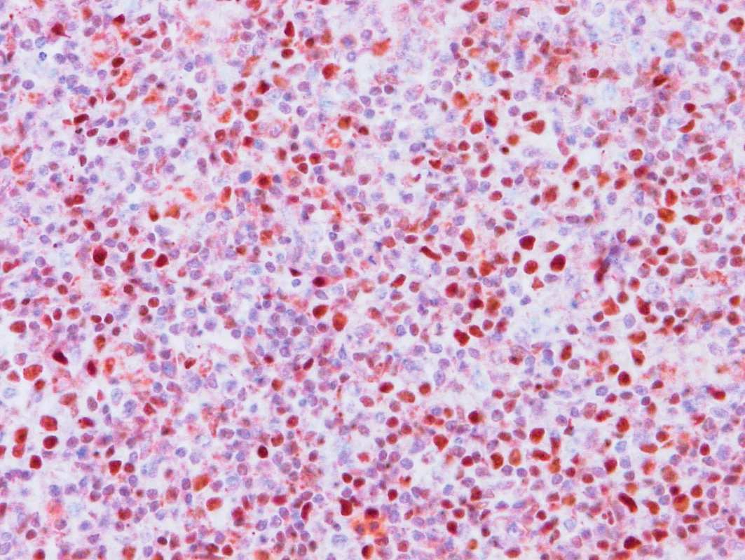 Vzorek z 1. bioptického odběru z roku 2013 – AITL
BCL6 pozitivita nádorových buněk.