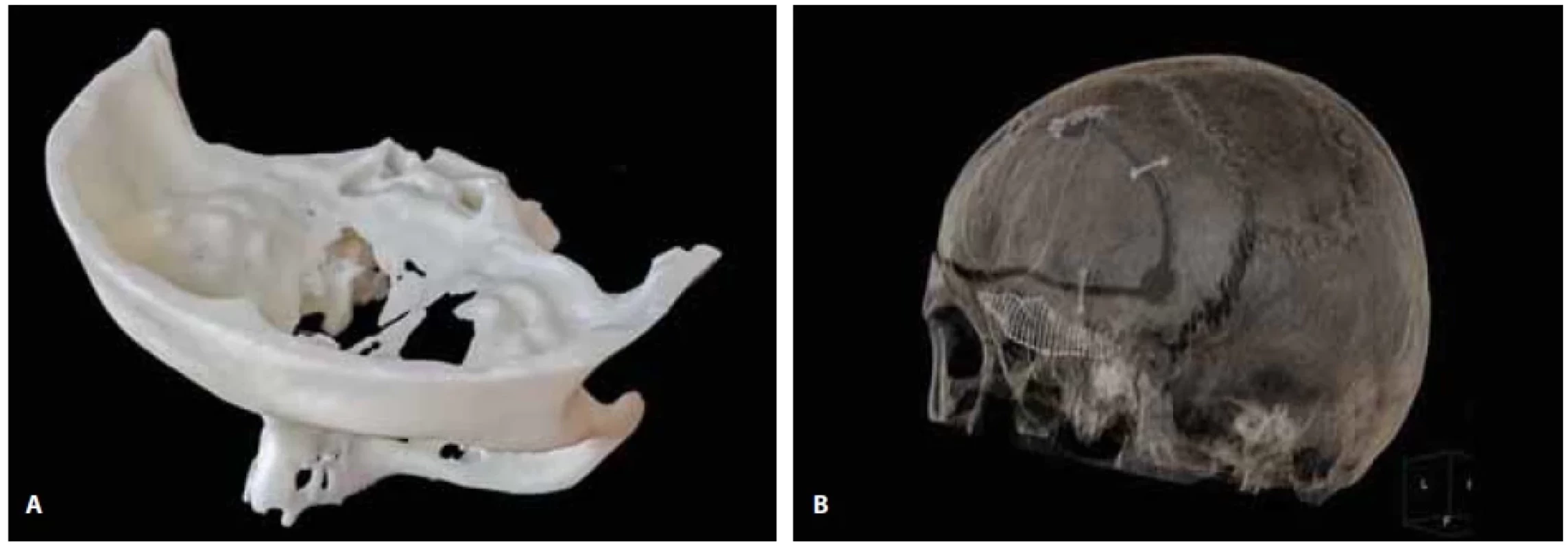 (A) 3D model of the anterior cranial base defect arising in Wegener’s granuloma. (B) CT reconstruction of the defect with a titanium mesh shaped according to the 3D model.