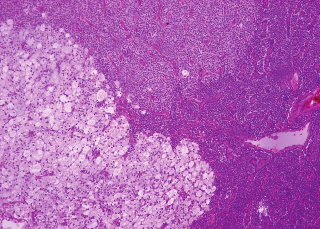 Parathyromatosis shows a proliferation of parathyroid chief cells. Focally, the cells are oval, with clear or basophilic cytoplasm and with mild nuclear enlargement (hematoxylin and eosin, magnifications x 200).