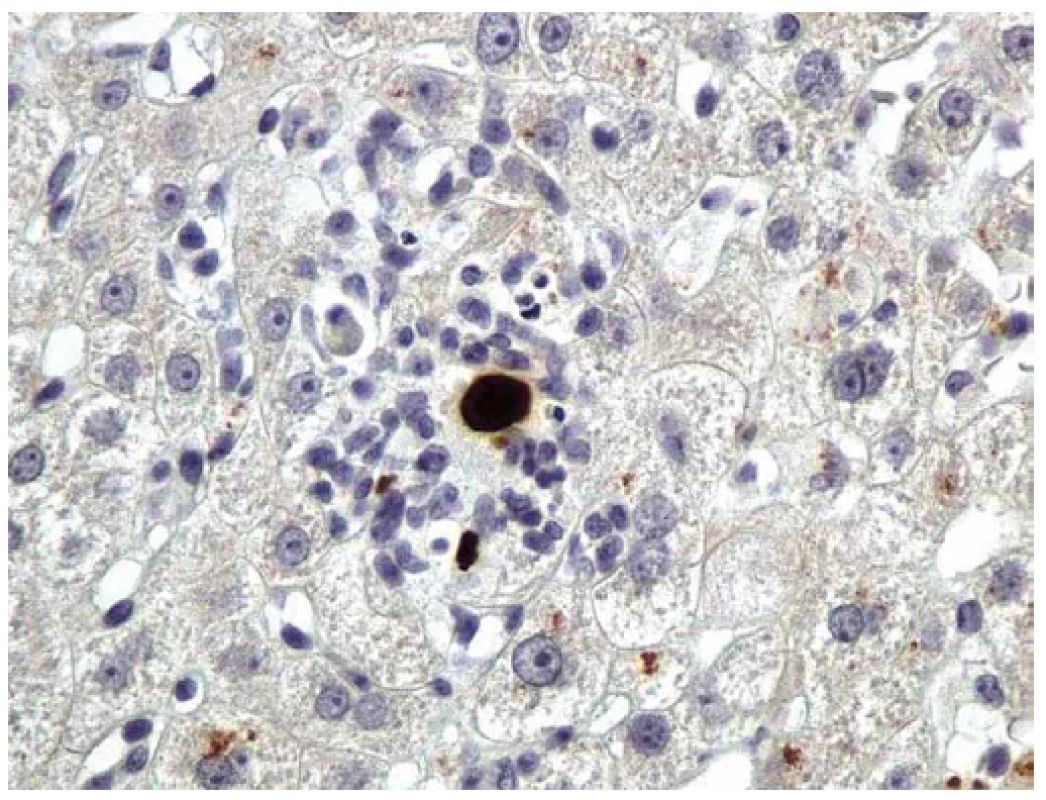 CMV hepatitida. Imunohistochemická detekce okamžitého časného antigenu CMV (buňky infikované CMV jsou hnědé). Primární myší monoklonální anti-CMV protilátka (klon CCH2 + DDG9, Dako), původní zvětšení 400×.
Fig. 2. CMV hepatitis. Immunohistochemical detection of CMV immediate early antigen (CMV/infected cells are brown). Primary mouse monoclonal anti-CMV antibody (clone CCH2 + DDG9, Dako), original magnification ×400.