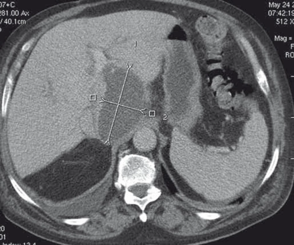 CT obraz abscesu v lobus caudatus pečene.
Fig. 8. CT image of an abscess in the caudate lobe of the liver.
