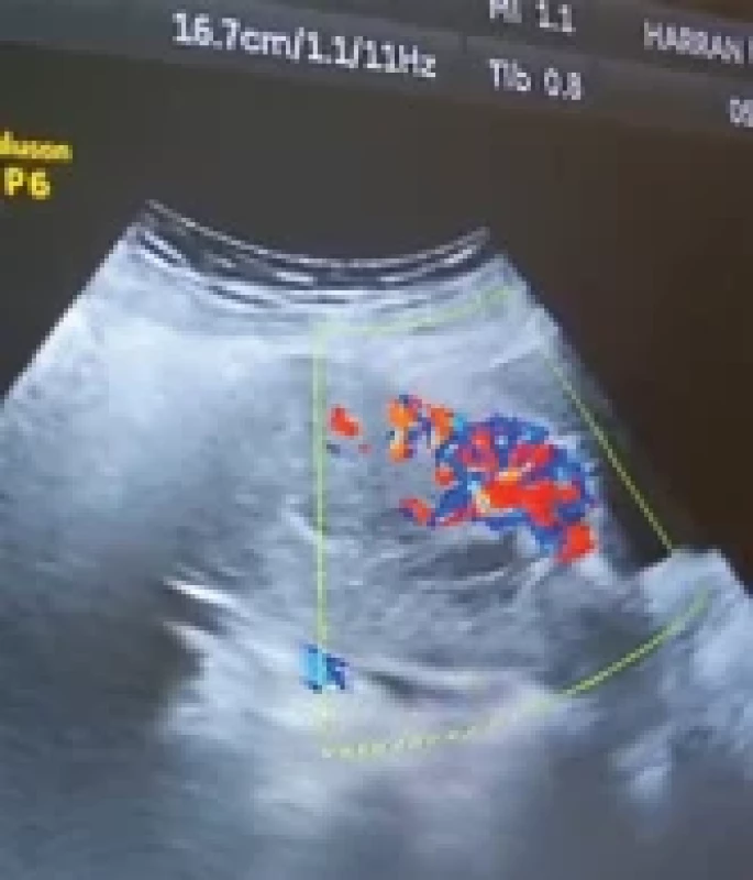 Transabdominal Doppler ultrasonography image. Obr. 1. Snímek z transabdominálního dopplerovského ultrazvuku.