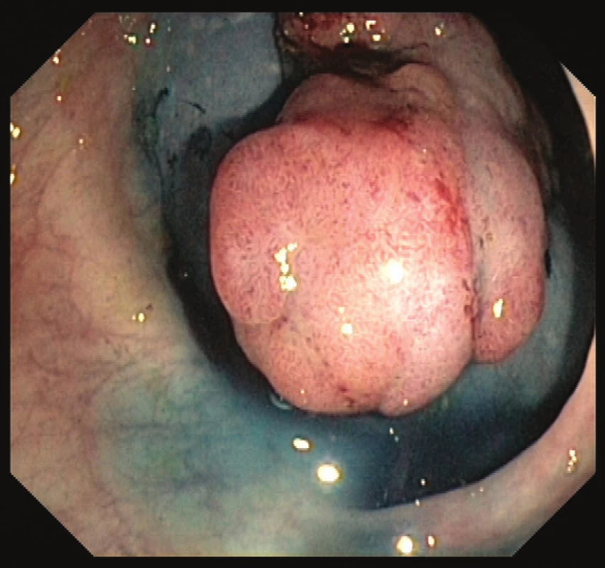 Přisedlý polyp s podpichem Patent Blue