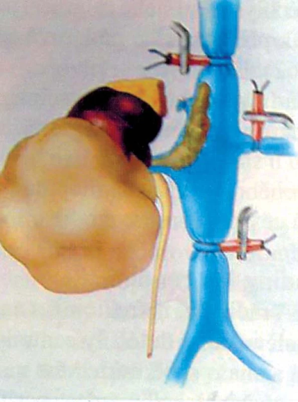 Tumor pravé ledviny s trombem hladiny II (naložení turniketů) [24].