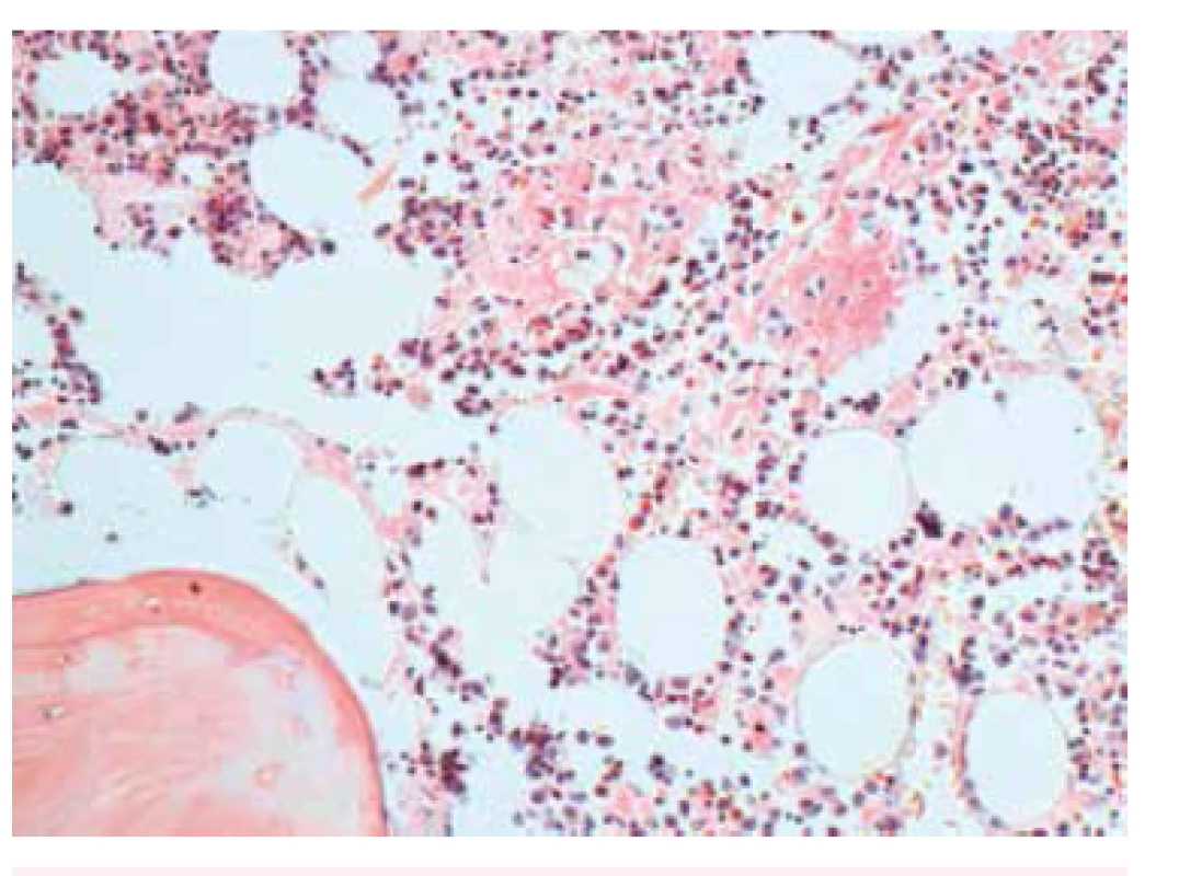 Kostní dřeň – histologický nález, Kongo červeň. Zvětšení 200x. Splývající Kongo pozitivní depozita intertrabekulárně v intersticiu.
