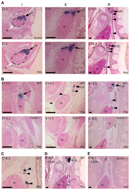 Incomplete separation of parathyroid and thymus organs results in extra-parathyroid PTH production.