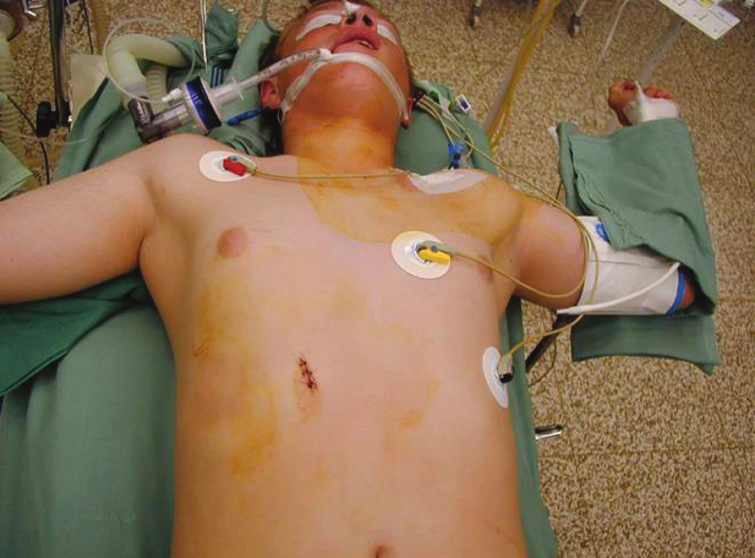 Bodná rána od skla v pravém podžebří
Fig. 1: Stab wound caused by glass, right side, below the rib cage