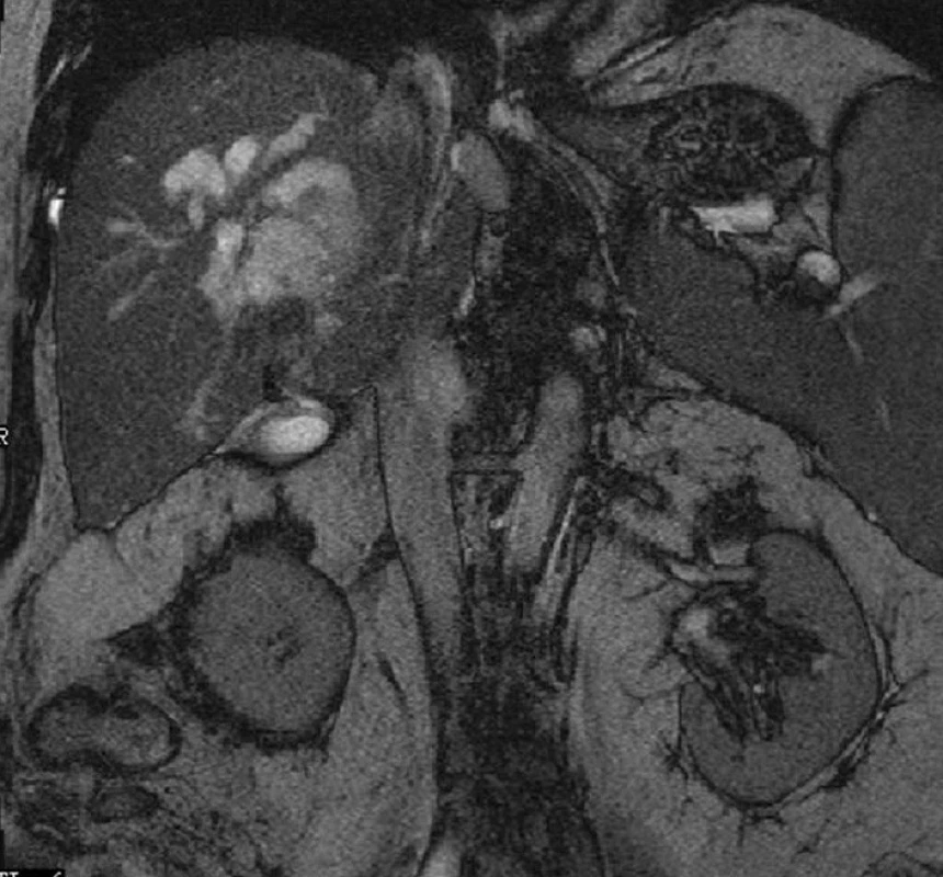 Rozpadový proces v pravém laloku jater s dilatací periferních žlučovodů – magnetická rezonance
Fig. 5: Dilatation of peripheral bile ducts caused by the decay process – magnetic resonance imaging