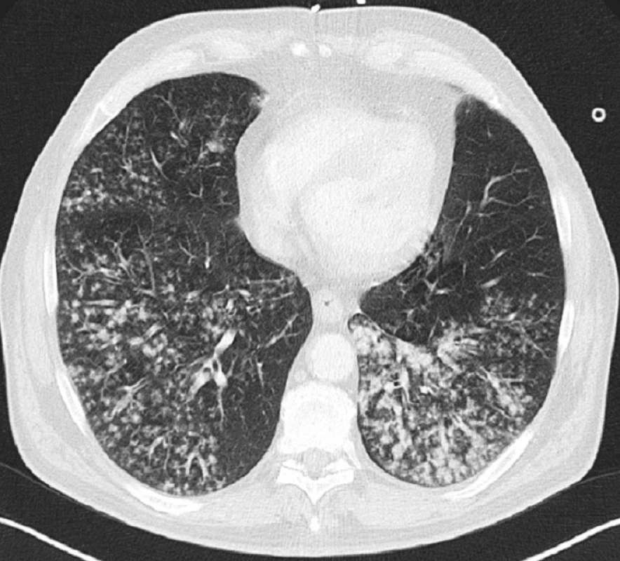 CT scan bazální oblasti plic s drobnoložiskovým procesem, 1. den
Fig. 1. CT scan of the pulmonary base with multiple small opacities detected, Day 1