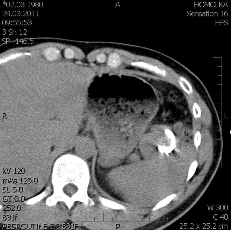 Evakuovaná cysta na CT (kazuistika 2)
Fig. 8: Evacuated cyst on CT (case 2)