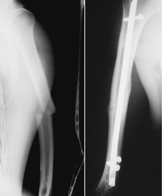a. RTG obraz zlomeniny diafýzy pažní kosti
Pic. 2a. X-ray picture of the humeral shaft fracture
b. RTG obraz zhojené zlomeniny pažní kosti po nitrodřeňové osteosyntéze retrográdně zavedeným zajištěným hřebem UHN
Pic. 2b. X-ray picture of the healed humeral shaft fracture after intramedullar osteosynthesis by retrograde unreamed humeral nail