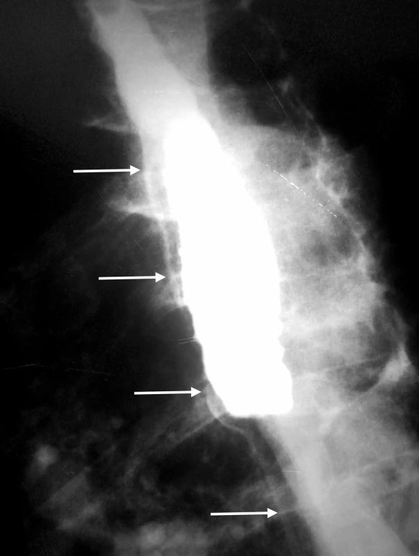 Extraluminálny únik kontrastnej látky?
Tenký prúžok kontrastu v skutočnosti vyznačuje priebeh falošného lúmenu (biele šipky). Rádiolucentný pás medzi pravým a falošným lúmenom vytvára tzv. príznak slizničného pruhu (mucosal strip sign)
Fig. 2: An extraluminal leak during the esophagography?
In fact, this is a „mucosal strip“ sign that is indicative of the intramural dissection with the presence of the false lumen (white solid arrows)