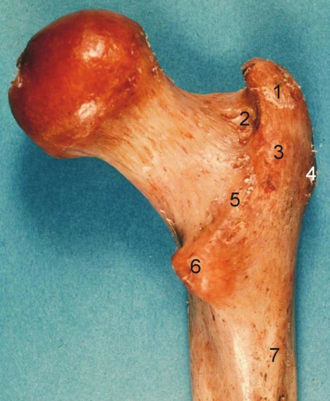 Proximální femur, pravá strana, pohled zezadu: 1 – fossa piriformis, 2 – fossa trochanterica, 3 – trochanter major, 4 – tuberculum vastoabductorium, 5 – crista intertrochanterica, 6 – trochanter minor, 7 – tuberositas glutea.
Fig. 2: Proximal femur, right side, posterior aspect: 1 – fossa piriformis, 2 – fossa trochanterica, 3 – trochanter major, 4 – tuberculum vastoabductorium, 5 – crista intertrochanterica, 6 – trochanter minor, 7 – tuberositas glutea.