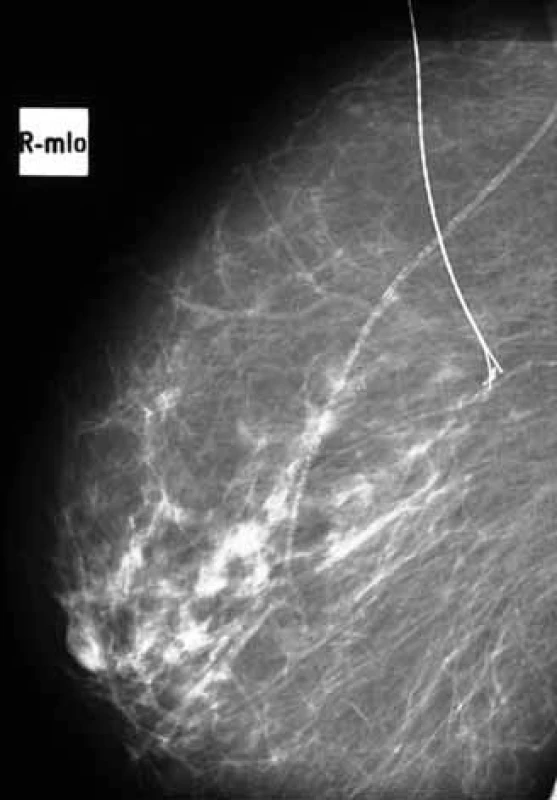 <em>Stereolokalizace</em> výsevu mikrokalcifikací pravé mammy v zevním horním kvadrantu u 41 leté ženy – převaha involuce, vazoskleroza, výsev mikrokalcifikací na rozloze 4 mm, typ mikrokalcifikací maligní – tečkovité + jemně granulární.