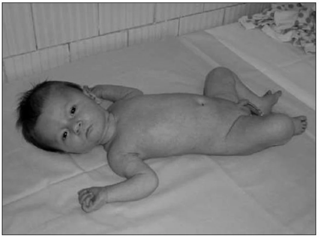 Kazuistika 2. Novorodenec mužského pohlavia s PWS, apatia, hypomímia, drobná faciálna
dysmorfia, minimálna spontánna pohybová aktivita, retentio testes bilat.
Fig. 3. Case report 2. A male newborn with PWS, apathy, hypomimia, minor facial dysmorphia, minimal motion activity, bilateral testes retention.
