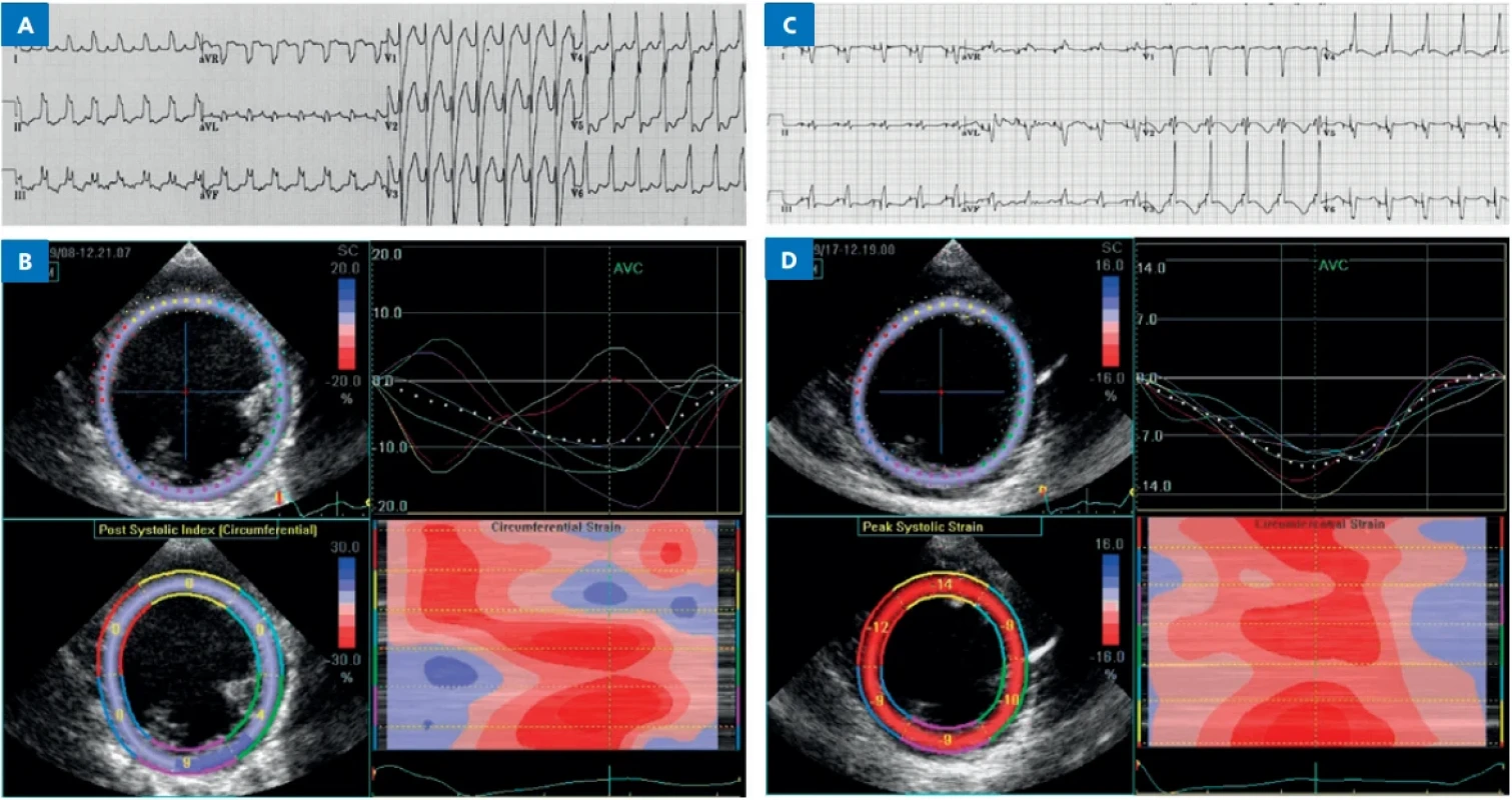 Vyšetření srdeční synchronie u 8měsíčního dítěte s těžký srdečním selháním. EKG křivka (A) zobrazuje sinusový rytmus s blokem levého Tawarova raménka s prodloužením QRS komplexu. Echokardiografická „speckle tracking“ technika zobrazuje významnou poruchu koordinace kontrakce šesti segmentů myokardu levé komory (B). Po aplikaci CRT se stimulací levé předsíně a současně obou srdečních komor se QRS interval na EKG významně zkrátil (C) a všechny segmenty myokardu (D) se kontrahovaly ve stejném časovém intervalu. (Zdroj: archiv Jana Marka)