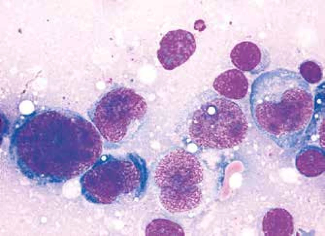 CD5+ DLBCL, anaplastická varianta (infiltrace lymfatické uzliny monstrózními anizomorfními lymfocyty s bazofilní a místy vakuolizovanou cytoplazmou, méně kondenzovaným jaderným chromatinem a zřetelnými bazofilními nukleoly)