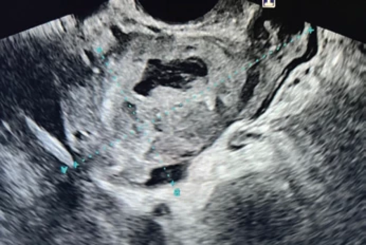Fotografie zobrazující mimoděložní graviditu zobrazitelnou za pomoci ultrazvukového vyšetření.</br> Fig. 2. A photograph showing an ectopic pregnancy visualized by ultrasound examination.