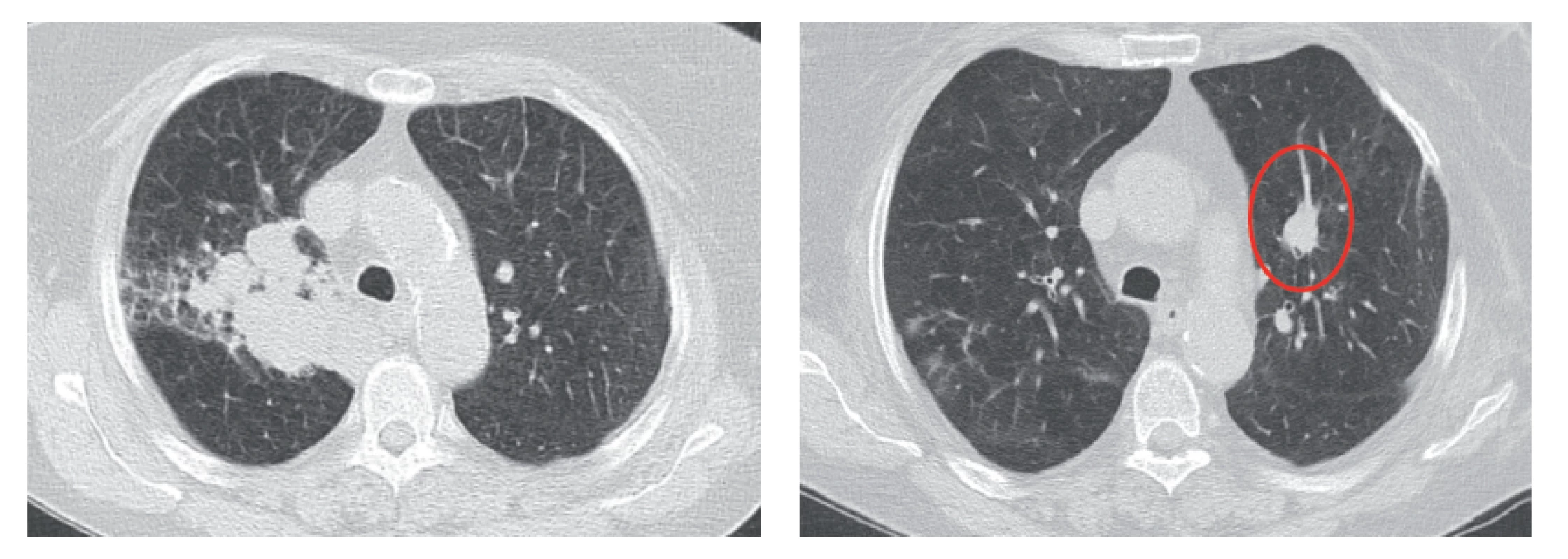CT scans with progressing tumor infiltration on the right and metastasis in the left lung after chemotherapy before the initiation of nivolumab